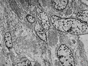 M,50y. | fibrous tumor - pleura M,50y. | fibrous tumor - pleura